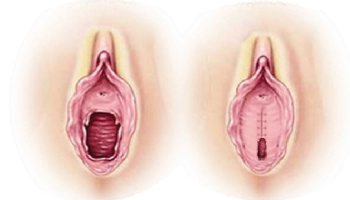 Hymenoplasty Clinic Lahore